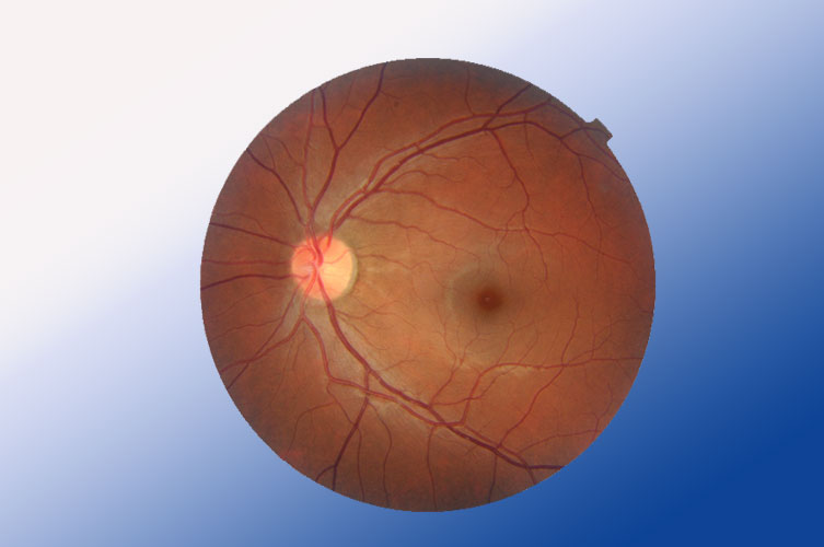 Diabetic Retinopathy