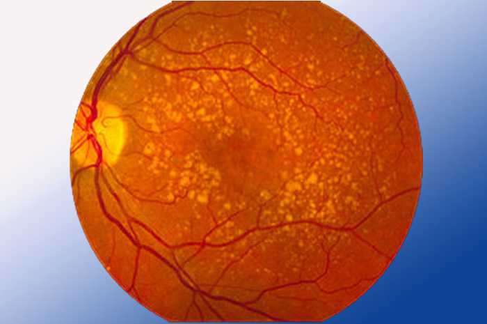 Age-related macular degeneration