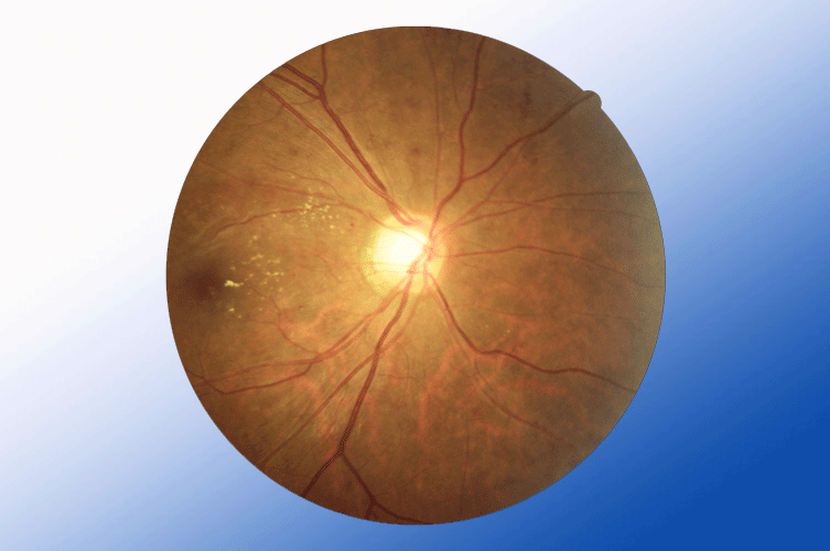 DR Retina